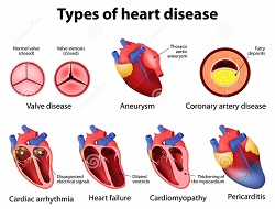 Heart Disease Types