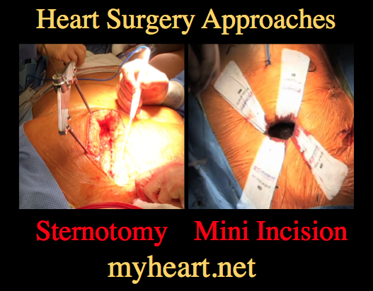 Heart Surgery Approaches