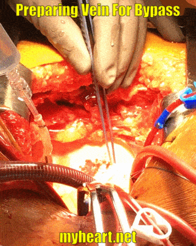 Preparing the vein for bypass