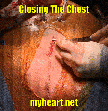 Closing the chest