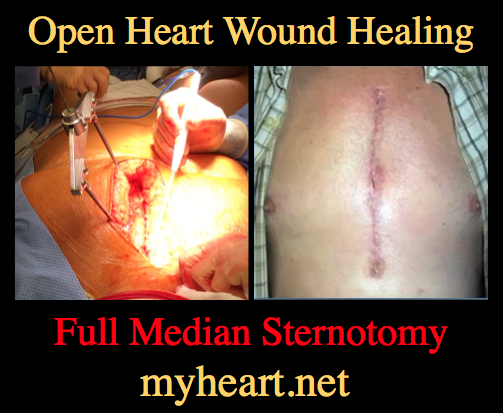 Open Heart wound healing