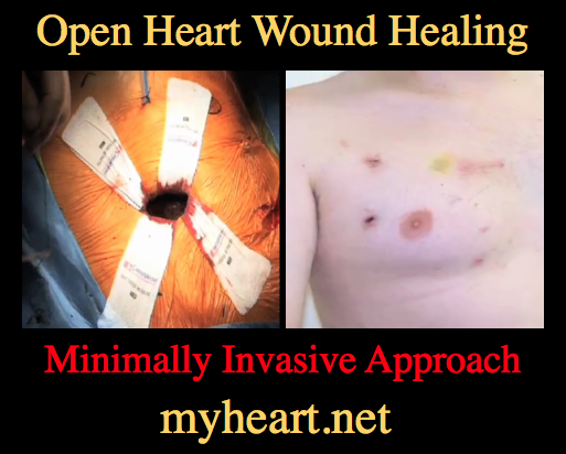 Open Heart wound healing